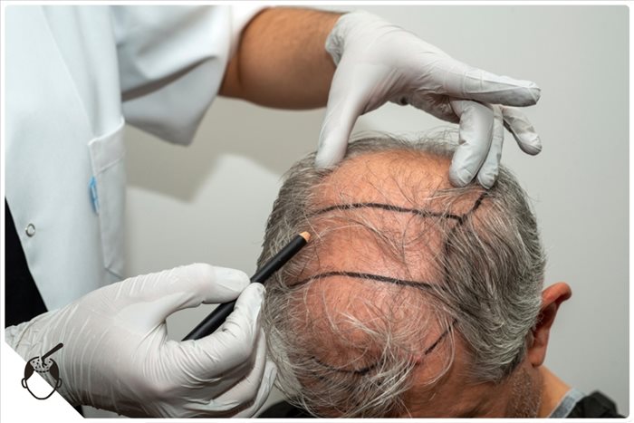 Greffe de cheveux à Nice : comment choisir la clinique ?